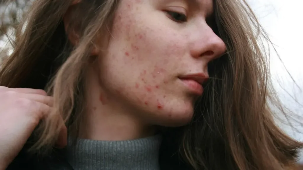 Two Straight Years of Record Measles: US Cases Climb to a 35-Year High - Featured image