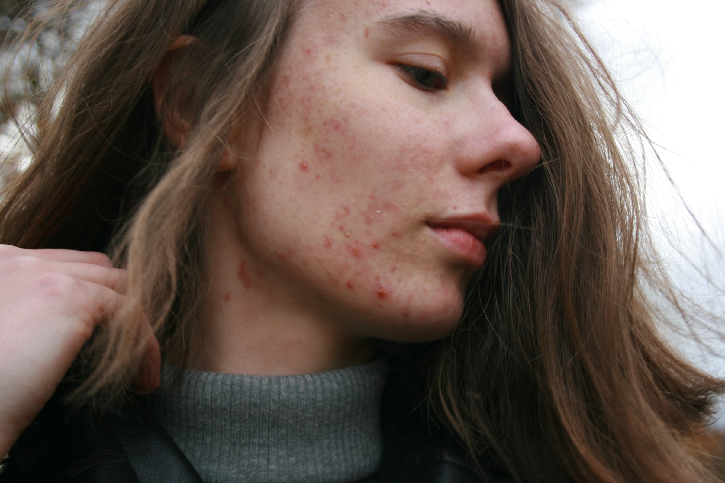 6 Plants That Look Harmless But Cause Painful Skin Reactions
