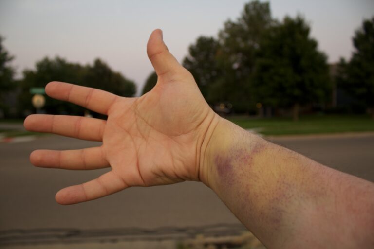 5 Foods That Naturally Reduce Bruising and Support Healing - Featured image