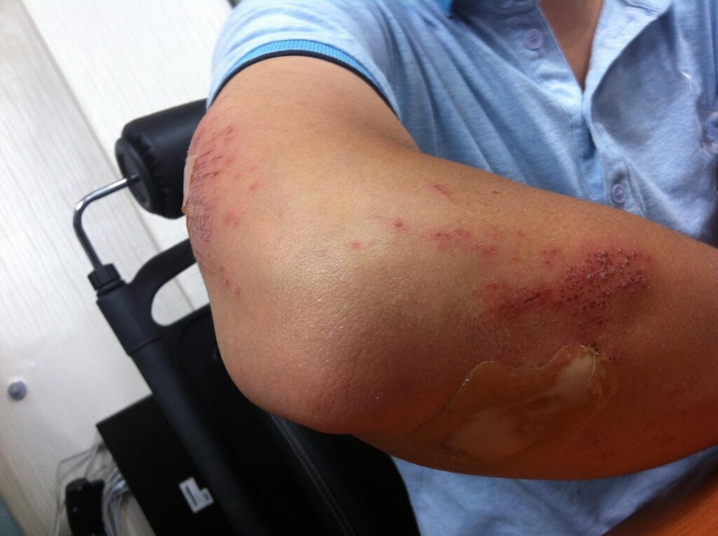 Why Some People Bruise Easier Than Others - Featured image